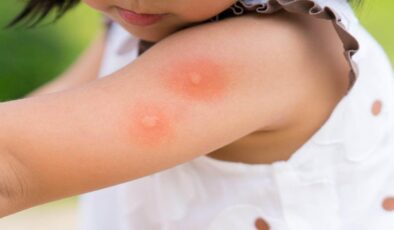 Bebek ve çocuklarda sivrisinek ısırıkları: Tedavisi ve önleme yolları