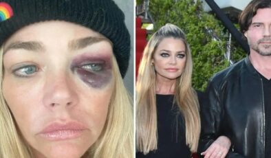 Gözleri mosmor olan Denise Lee Richards’tan eşine ağır suçlamalar: Beni öldürmeye çalıştı