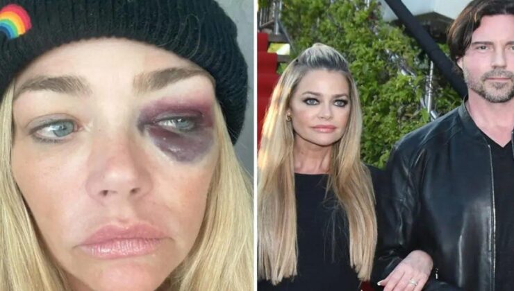 Gözleri mosmor olan Denise Lee Richards’tan eşine ağır suçlamalar: Beni öldürmeye çalıştı