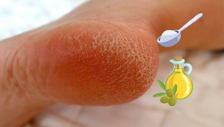 Çatlamış topuklara mucize çözüm! Sadece 2 malzeme ile yumuşacık oluyor