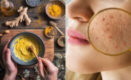 Zerdeçal ve bal maskesiyle aknelere savaş açın!