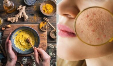 Zerdeçal ve bal maskesiyle aknelere savaş açın!