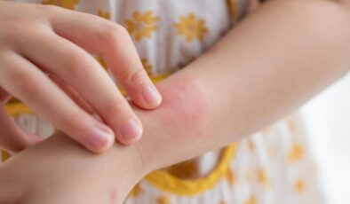 Kaşıntı deyip geçmeyin: Çocuklarda 6 haftadan fazla sürüyorsa dikkat!