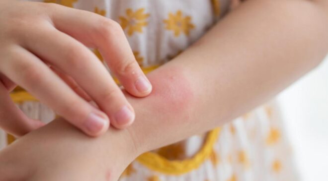Kaşıntı deyip geçmeyin: Çocuklarda 6 haftadan fazla sürüyorsa dikkat!