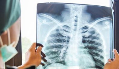 Tekrarlayan zatürreyi hafife almayın: Kanser belirtisi olabilir!