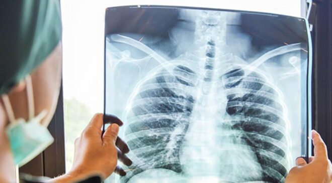 Tekrarlayan zatürreyi hafife almayın: Kanser belirtisi olabilir!