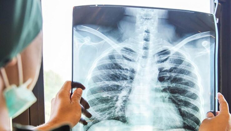 Tekrarlayan zatürreyi hafife almayın: Kanser belirtisi olabilir!