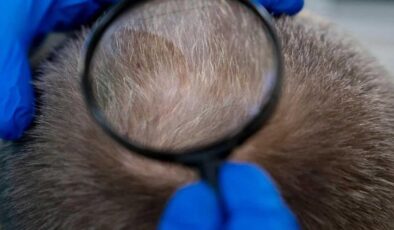 Erkek tipi saç dökülmesinde çığır açan adım: Clascoterone!