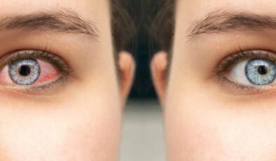 Uzmanı uyarıyor: Kış aylarında soğuk hava ve kapalı ortamlar, göz sağlığını tehdit ediyor!