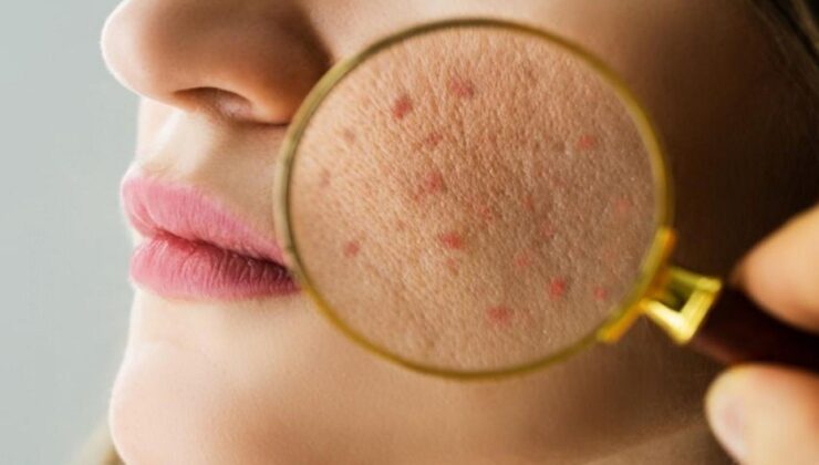 Yetişkinlerde akne alarmı: Uzman isim tetikleyen faktörleri sıraladı