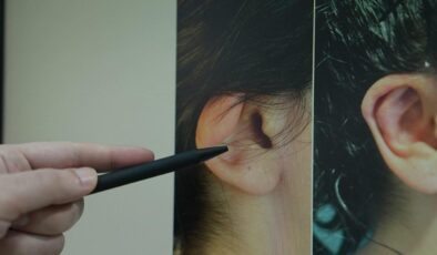 Uzman isim aileleri uyardı: Kepçe kulak özgüven kaybına yol açabiliyor