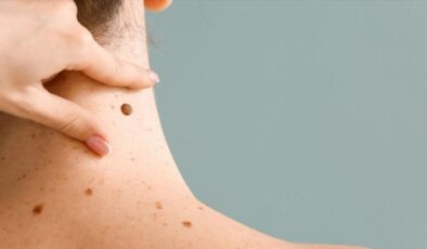 Uzman isim açıkladı: Çocuklarda benler masum mu, risk sinyali mi?