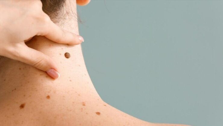 Uzman isim açıkladı: Çocuklarda benler masum mu, risk sinyali mi?