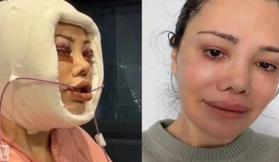Yüz nakli geçirmişti! Didem Ceran kötü haberi duyurdu