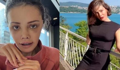 Yüz nakli sonrası kaşında saç çıktı! Didem Ceran’dan şaşırtan paylaşım
