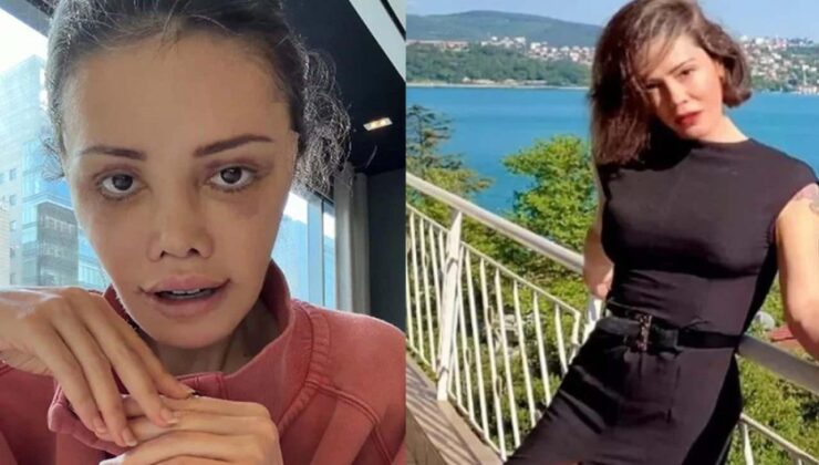 Yüz nakli sonrası kaşında saç çıktı! Didem Ceran’dan şaşırtan paylaşım