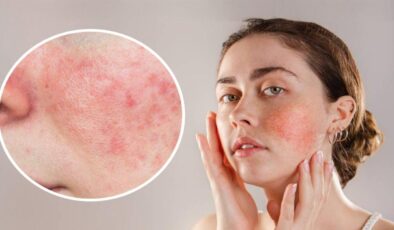 Gül hastalığı sandığınızdan daha yaygın: Gül hastalığının ilk belirtileri nelerdir?