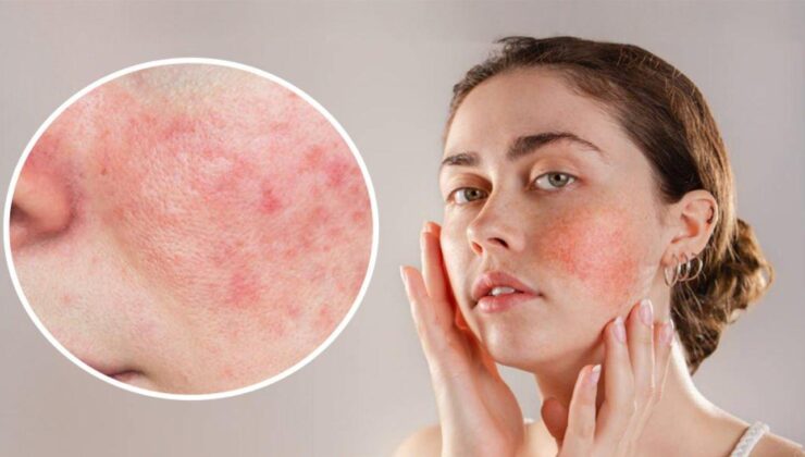 Gül hastalığı sandığınızdan daha yaygın: Gül hastalığının ilk belirtileri nelerdir?