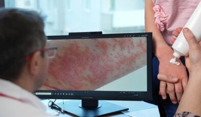 Uzman isim uyardı: Egzaması olan çocuklarda gereksiz diyet alerjiyi tetikleyebilir