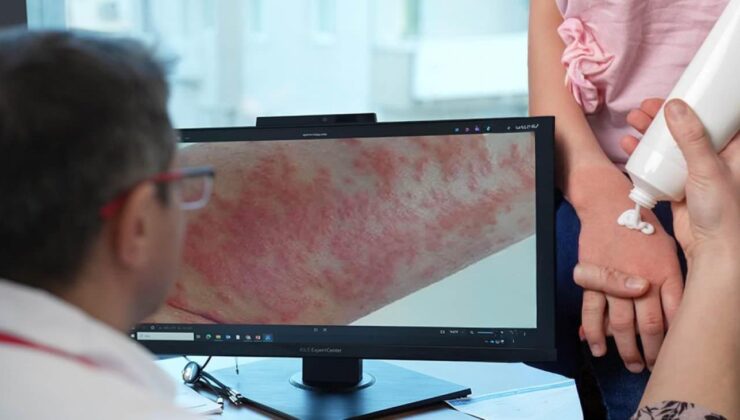 Uzman isim uyardı: Egzaması olan çocuklarda gereksiz diyet alerjiyi tetikleyebilir