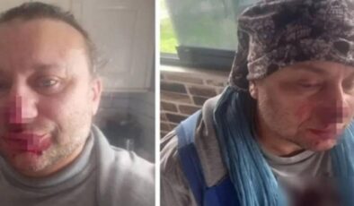 Yoğun bakımdan çıkan Onur Akay pitbull dehşetini anlattı: ‘Ölümden döndüm’