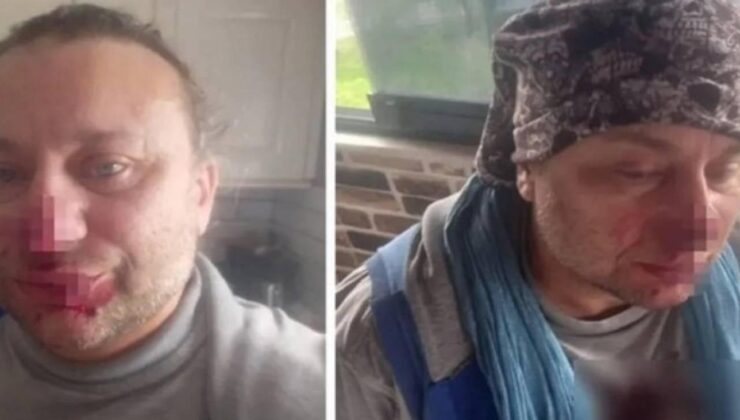 Yoğun bakımdan çıkan Onur Akay pitbull dehşetini anlattı: ‘Ölümden döndüm’