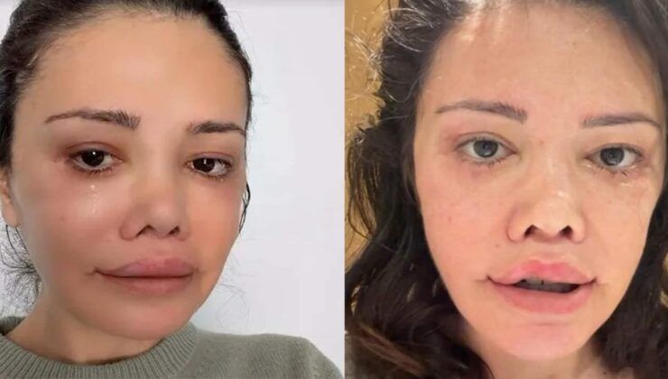 Yüz nakli olan Didem Ceran’ın gençlik sırrı yumurta çıktı!